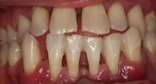 磨牙神器成人固定方法视频,视频教程详解-第1张图片-成人动漫3d无尽视频