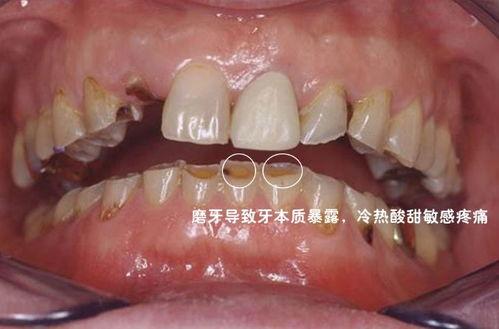 成人帮忙磨牙好吗视频大全,专业视频解析助你安心睡眠-第3张图片-成人动漫3d无尽视频