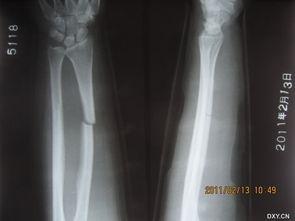 成人骨折治疗方法视频,跟随视频学习成人骨折治疗方法-第1张图片-成人动漫3d无尽视频