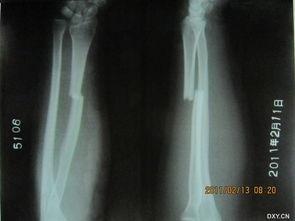 成人骨折治疗方法视频,跟随视频学习成人骨折治疗方法-第2张图片-成人动漫3d无尽视频