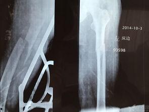 成人骨折治疗方法视频,跟随视频学习成人骨折治疗方法-第3张图片-成人动漫3d无尽视频